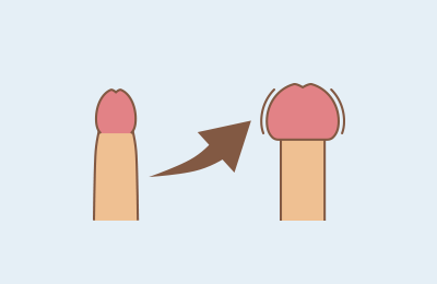 亀頭増大　大分