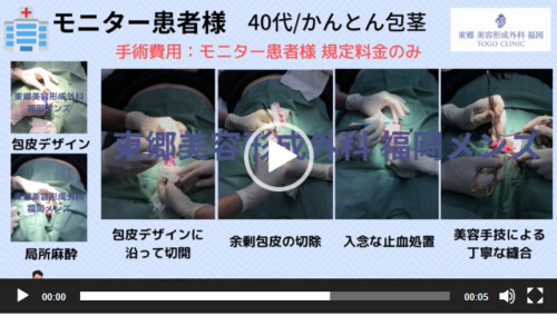 包茎手術　治療モニター｜４０代 　手術動画 一部公開　