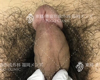 術後1か月後の経過来院の際の状態写真3