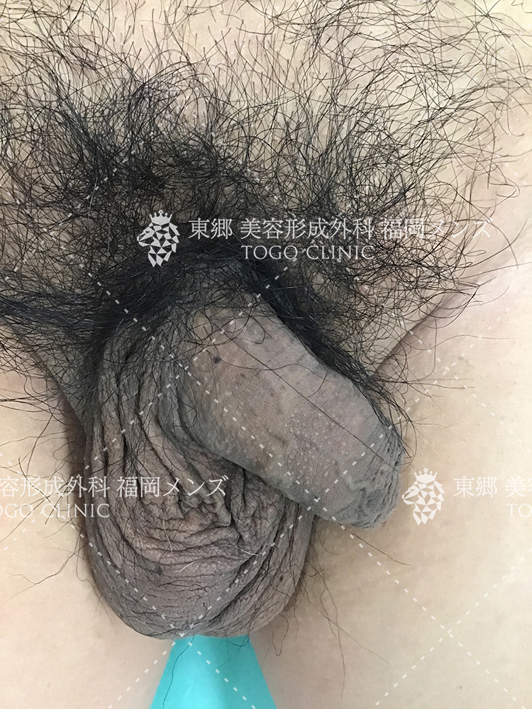 仮性包茎 症例写真