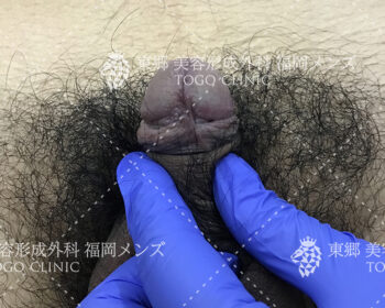 臨床写真　術前の状態3