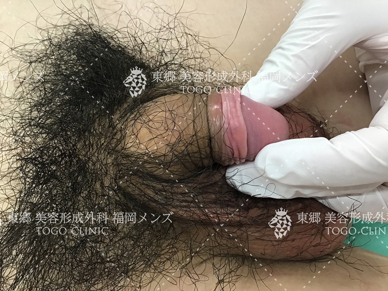 カントン包茎　締め付け