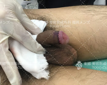 手術直後の縫合部の状態写真2