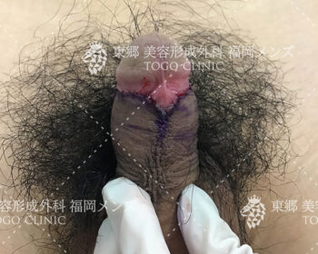 手術直後の縫合部の状態写真3