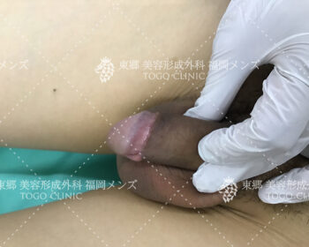 術後1か月後の経過来院の際の状態写真2