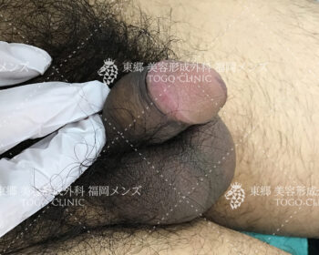 術後1か月後の経過来院の際の状態写真2