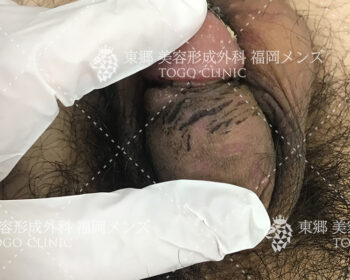 抜糸時の経過来院の際の状態写真1