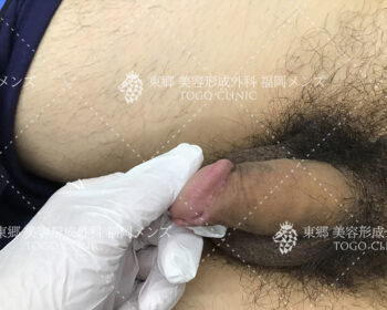 抜糸時の経過来院の際の状態写真2