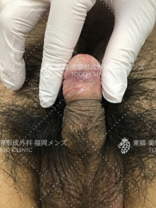 カントン包茎　症例写真