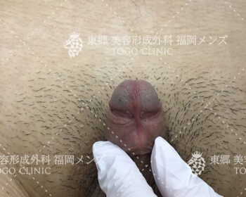 臨床写真 術前の状態3