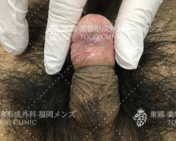 臨床写真　術前の状態3