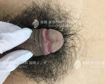 臨床写真 術前の状態3