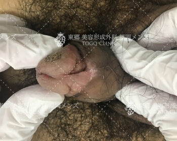 抜糸時の経過来院の際の状態写真3