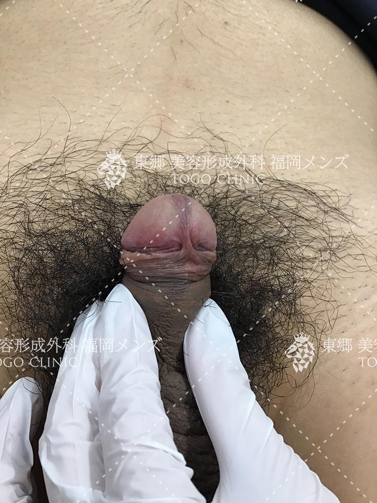 カントン包茎　症例写真