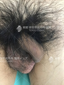 仮性包茎