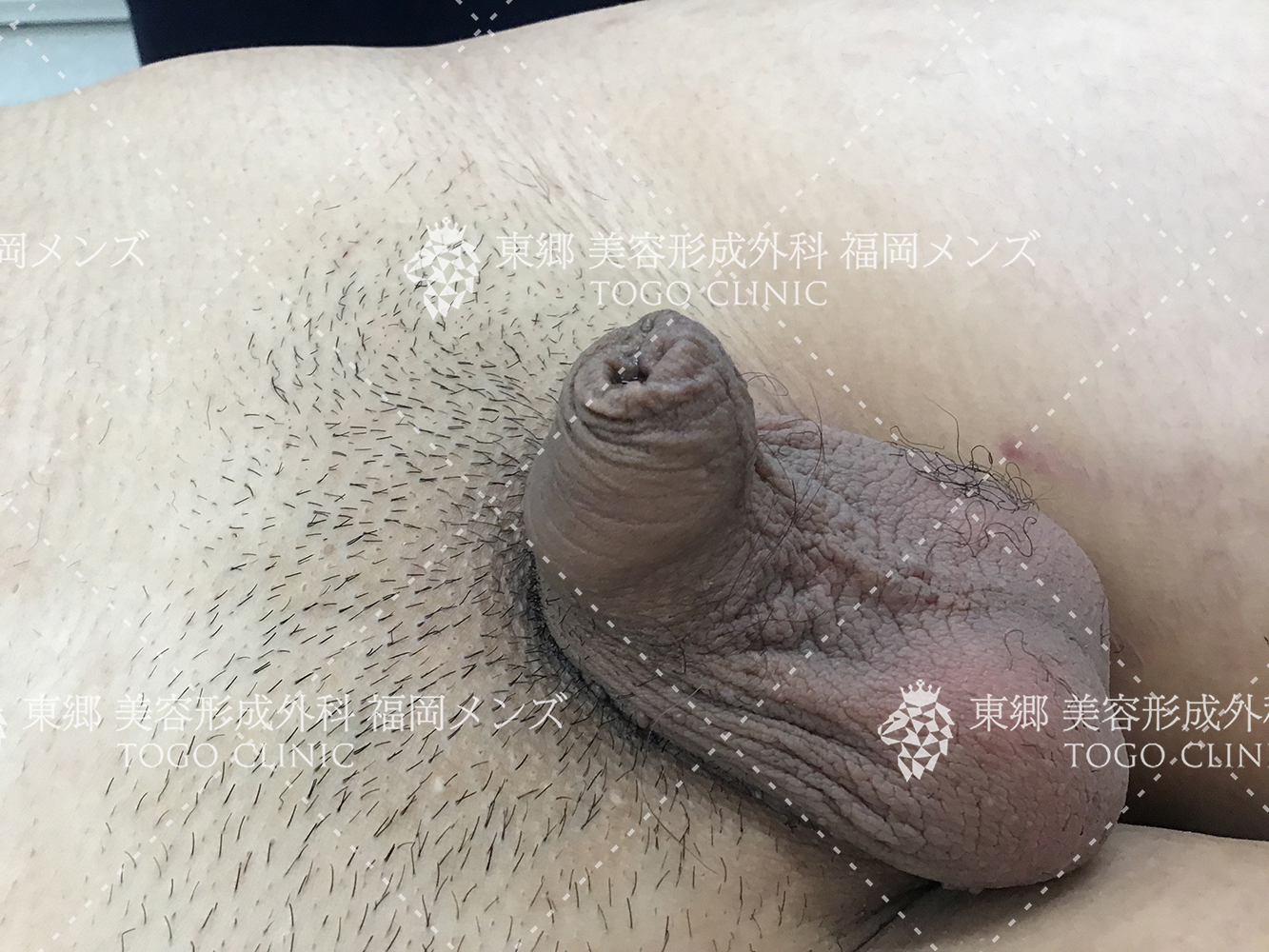 真性包茎 臨床写真