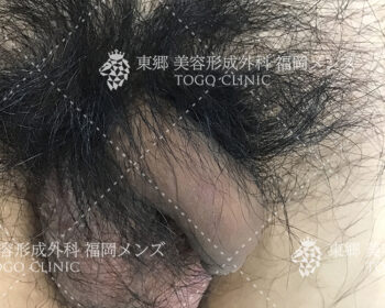 かんとん包茎　モニター患者様⑥　術前写真