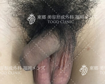 仮性包茎　モニター患者様⑧　術前写真