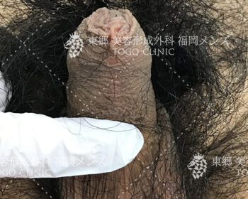臨床写真　術前の状態3